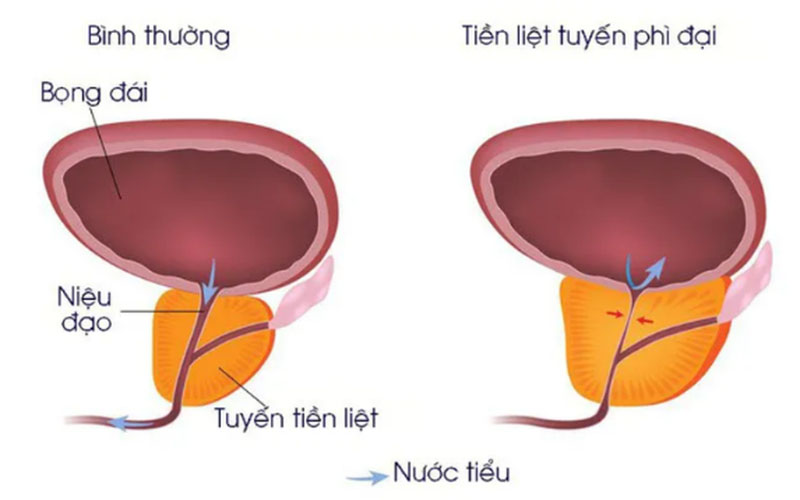 Tuyến tiền liệt ảnh hưởng trực tiếp đến chất lượng tinh dịch và sinh sản.
