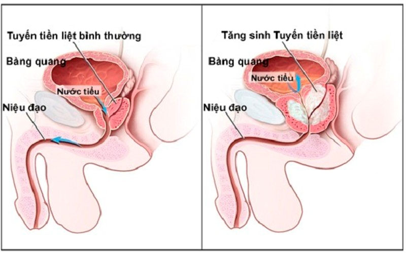 Tuyến tiền liệt nằm ngay dưới bàng quang và bao quanh niệu đạo