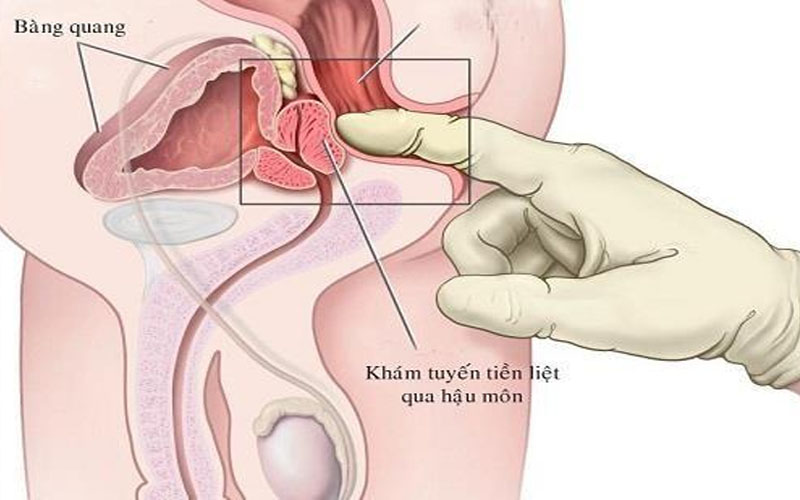 Phì đại tuyến tiền liệt gây chèn ép niệu đạo và rối loạn tiểu tiện 